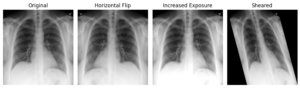 Panel showing a medical image with common data augmentation transformations, including flipping, rotation, brightness change and shear.